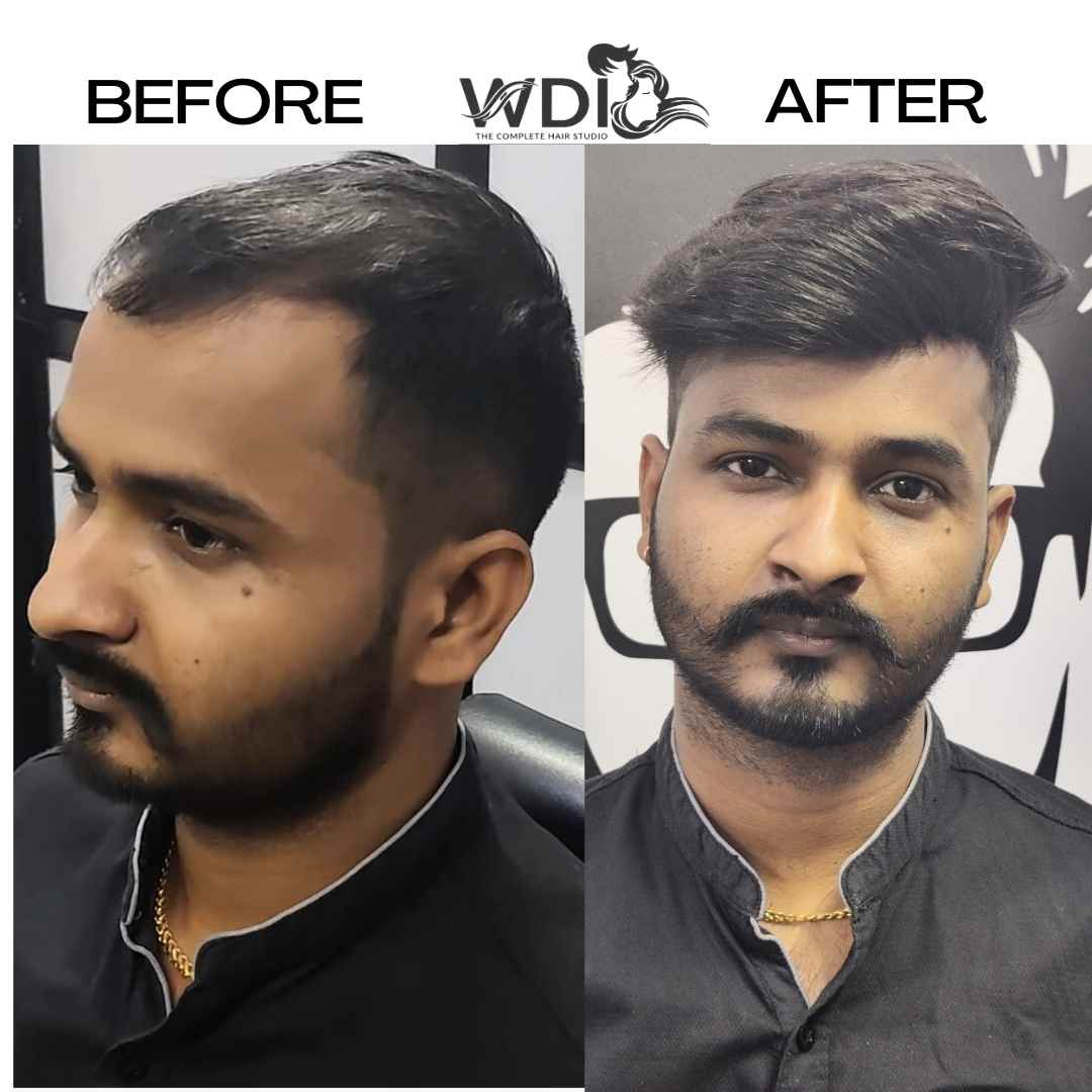 hair fixing in bangalore 