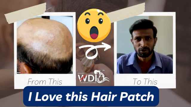 Hair Patch in Bangalore: A Solution for Hair Loss