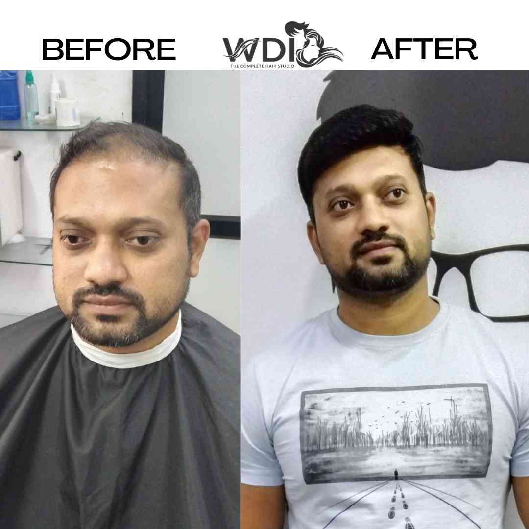 hair fixing in bangalore